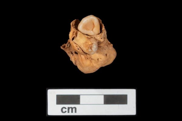 Tumor raro e bizarro é descoberto em túmulo egípcio de 3 mil anos
