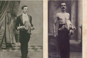A incrível história de Jean Libbera, o italiano que tinha um gêmeo parasita em seu peito