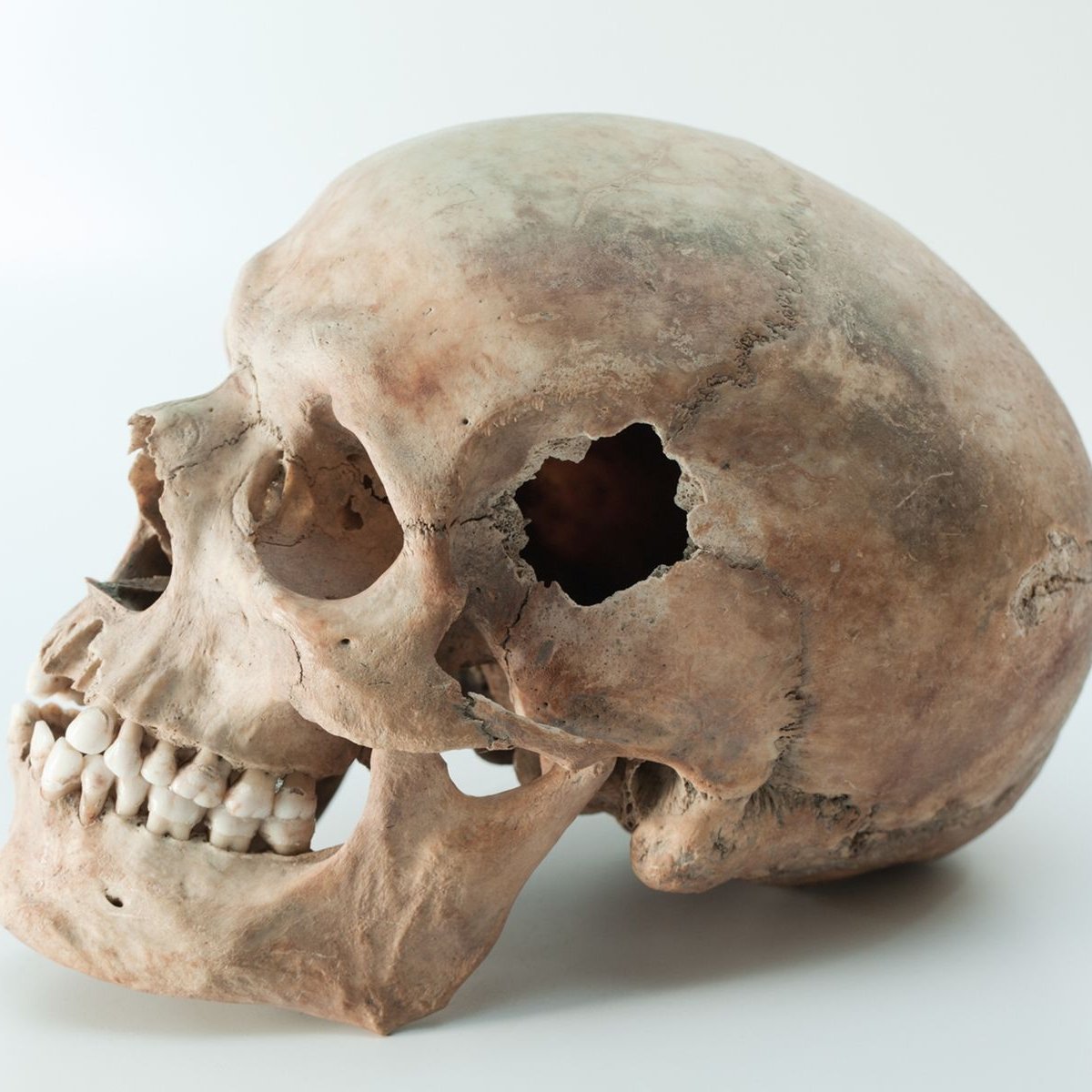 Cirurgia neolítica: por que (e como) europeus antigos andavam com um buraco no crânio?
