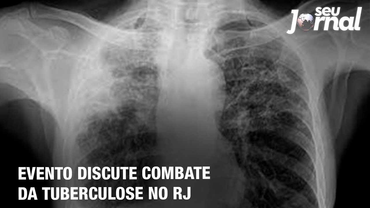 Evento discute combate da Tuberculose no RJ